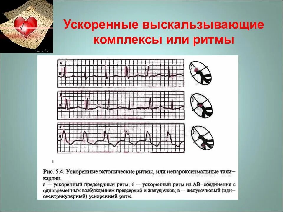 Ритм предсердий у ребенка. Медленные замещающие выскальзывающие ритмы экг. медленные замещающие выскальзывающие комплексы и ритмы. замещающий предсердный комплекс экг. что такое выскальзывающий ритм из предсердий.
