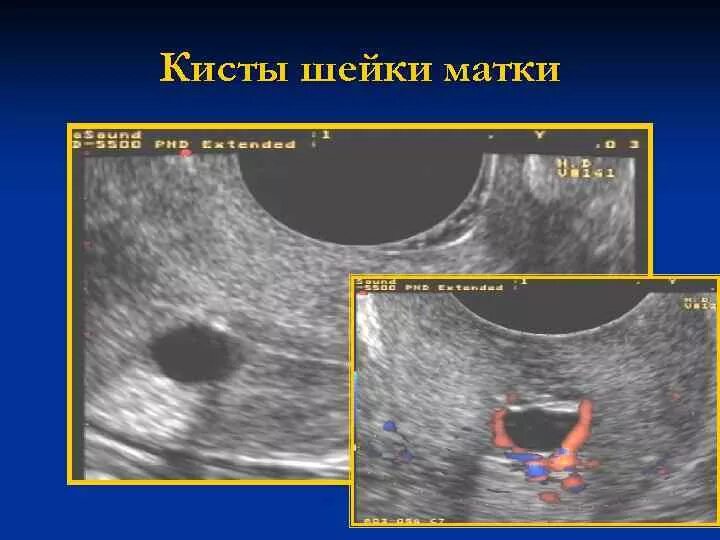 Кистозно расширенная железа. Кисты в шейке матки на УЗИ что это.