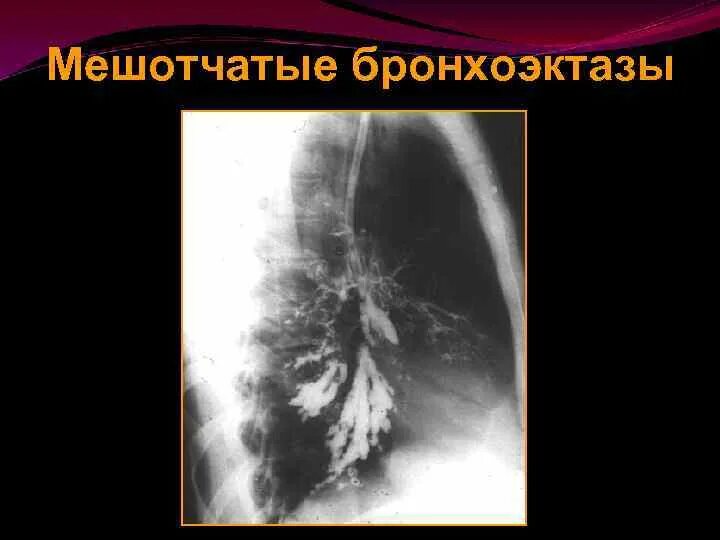 Бронхоэктаз правого легкого. Бронхография при бронхоэктатической болезни. Бронхоэктазы в легких мешотчатые. Мешотчатые бронхоэктазы рентген. Клиническая картина бронхоэктатической болезни.
