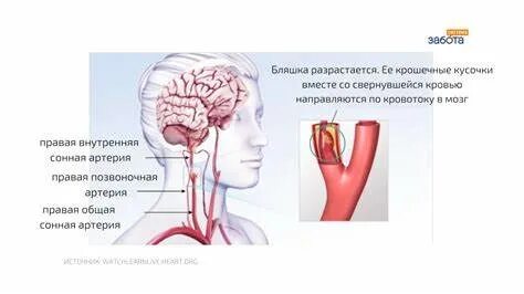 Питание после инсульта ишемического