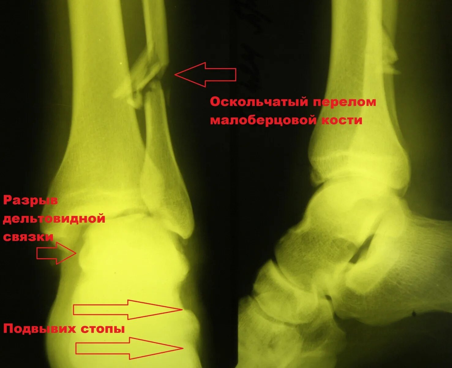 Good day) Dear participants of the group, diagnosis: closed fracture of the lowe