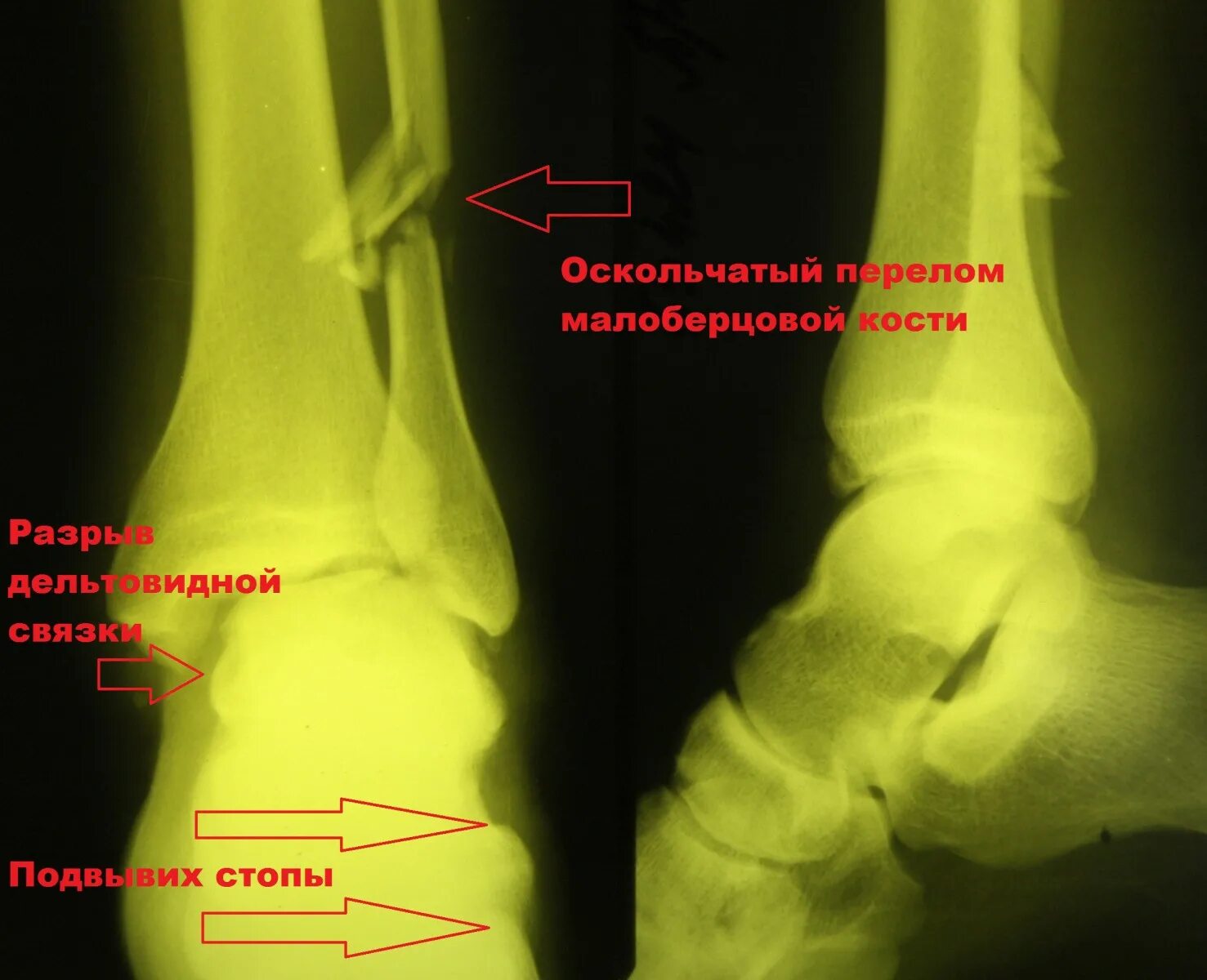 Осколочный перелом малой берцовой кости. Оскольчатый перелом малой берцовой кости. Пронационный перелом лодыжки. Перелом лодыжки и малоберцовой кости со смещением.