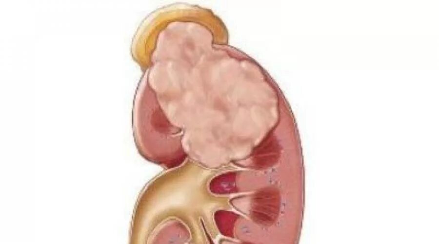 Опухоль почечной лоханки кт. С одной почка может жить. Сложно ли жить с 1 почкой?. Рак почки инвалидность