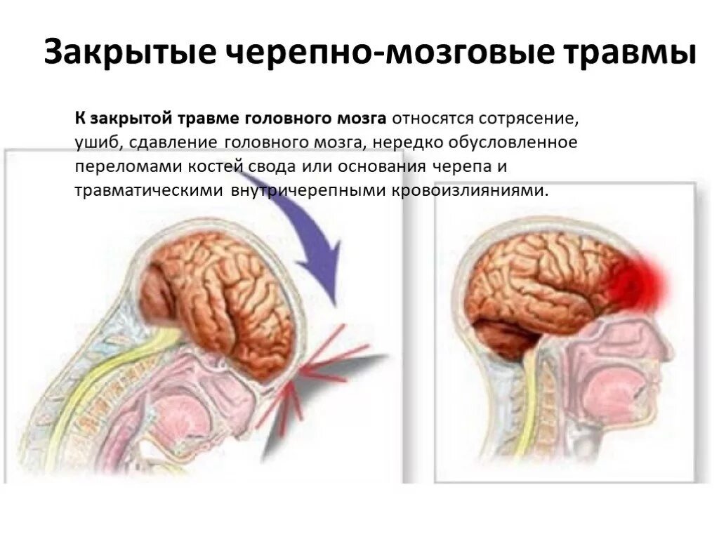 Закрытый черепно мозговой перелом. Сотрясение головного мозга. отрясениеголовного мозга. черепно-мозговая травма.