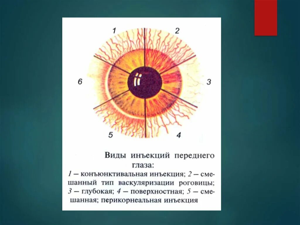 Заболевания сосудистой оболочки. Заболевания сосудистой оболочки глаза. Аномалии сосудистой оболочки глаза. Типы инъекции глазного яблока. Воспалительные патологии сосудистой оболочки глаза.