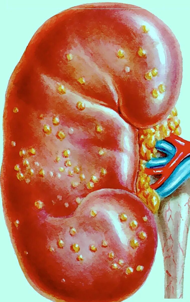Полинифрит почек хронический пиелонефрит. Острый нефрит пиелонефрит. Нефрит воспаление почек. Нефрит гламированный почек. Острый пиелонефрит болезнь