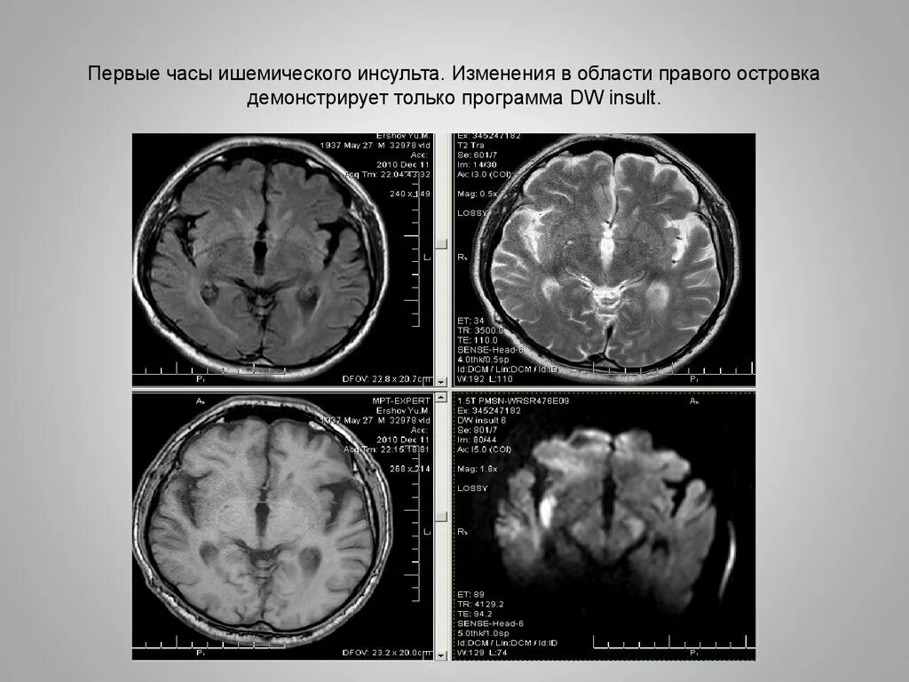 Ишемические изменения головного мозга. Мрт острое нарушение мозгового кровообращения по ишемическому типу. Ишемический ОНМК мрт. Ишемический инсульт на кт головного мозга. ОНМК по ишемическому типу мрт.