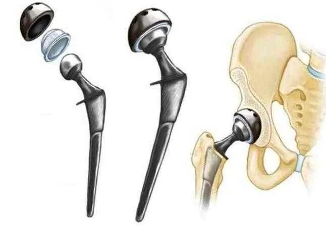 Титановый тазобедренный эндопротез. Эндопротез шейки бедра. Эндопротезирование тазобедренного сустава. Тазобедренный эндопротез Зиммер. Суть операции эндопротезирования