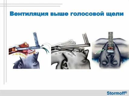 Расширяющую голосовую щель