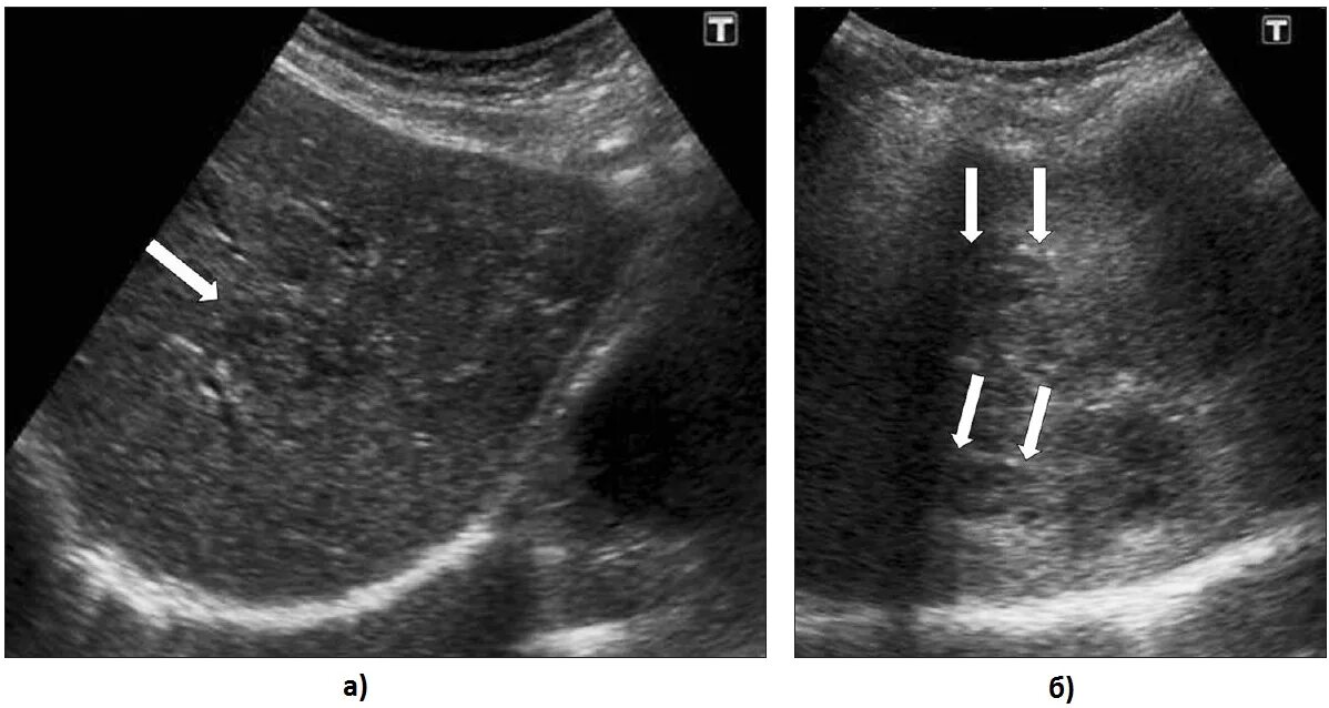 Расширение желчных протоков на узи. Сладж-синдром желчного пузыря на узи. Холангит – воспалительное заболевание желчных протоков. Желчный уплотнен. Ультразвуковой признак острого деструктивного холецистита.
