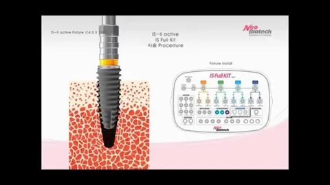 Neobiotech импланты отзывы