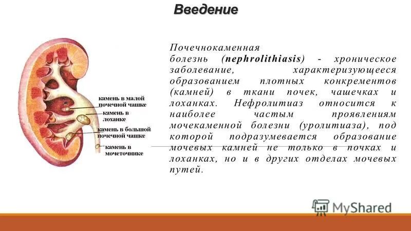 В почечных лоханках собирается. Конкремент лоханки почки. Строение почки камни в лоханке. Почечнокаменная болезнь (нефролитиаз).