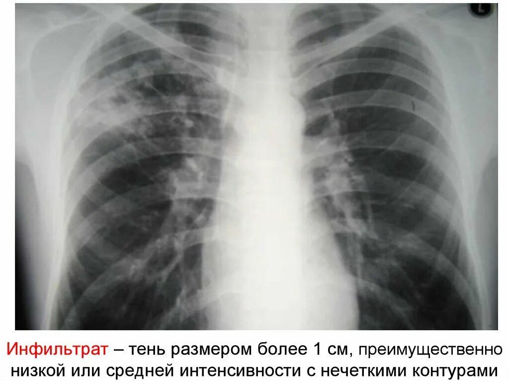 Туберкулез легких в фазе инфильтрации. Инфильтративный туберкулёз инфильтраты. Инфильтративный туберкулез рентгенография. Инфильтративный туберкулез рентген. Инфильтративный туберкулёз лёгких рентген.