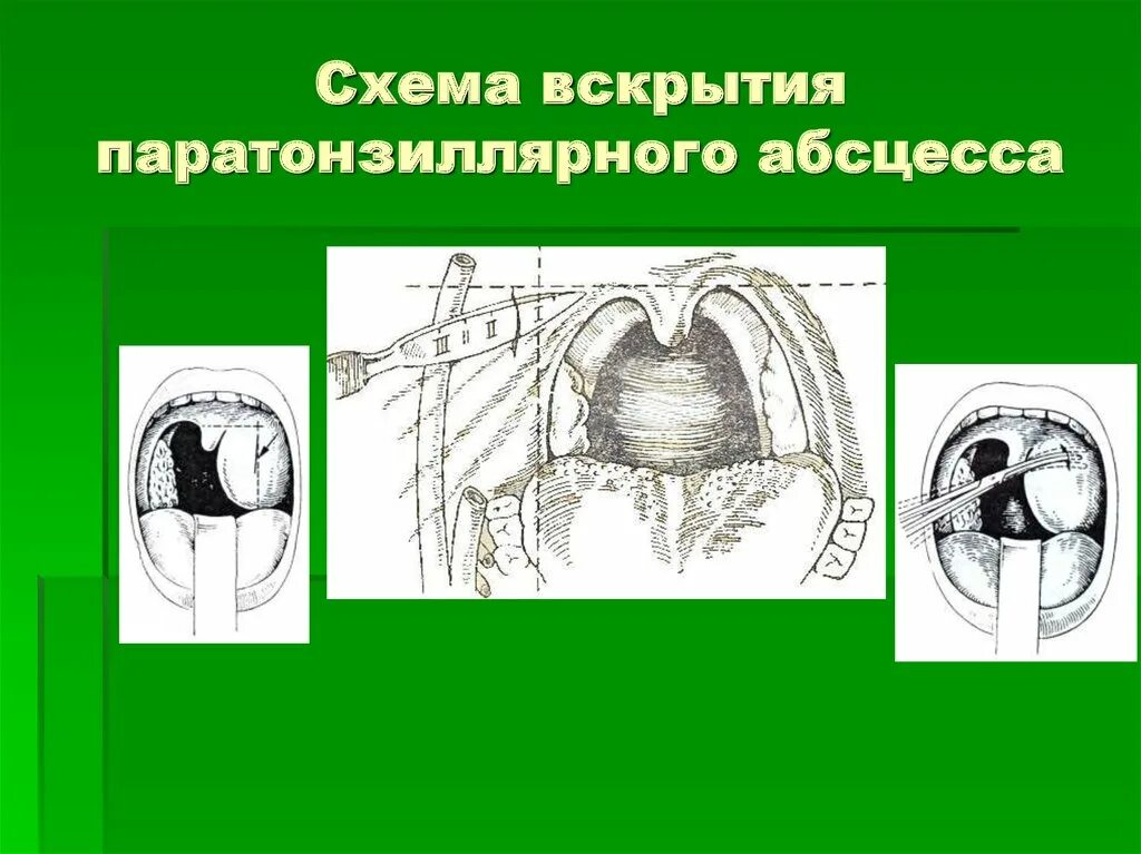 Асимметрия зева