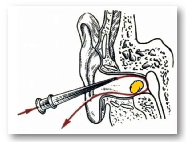 Как прочистить серную пробку. Промывание уха серная пробка. Кюретаж наружного слухового прохода. Промывание серных пробок алгоритм.