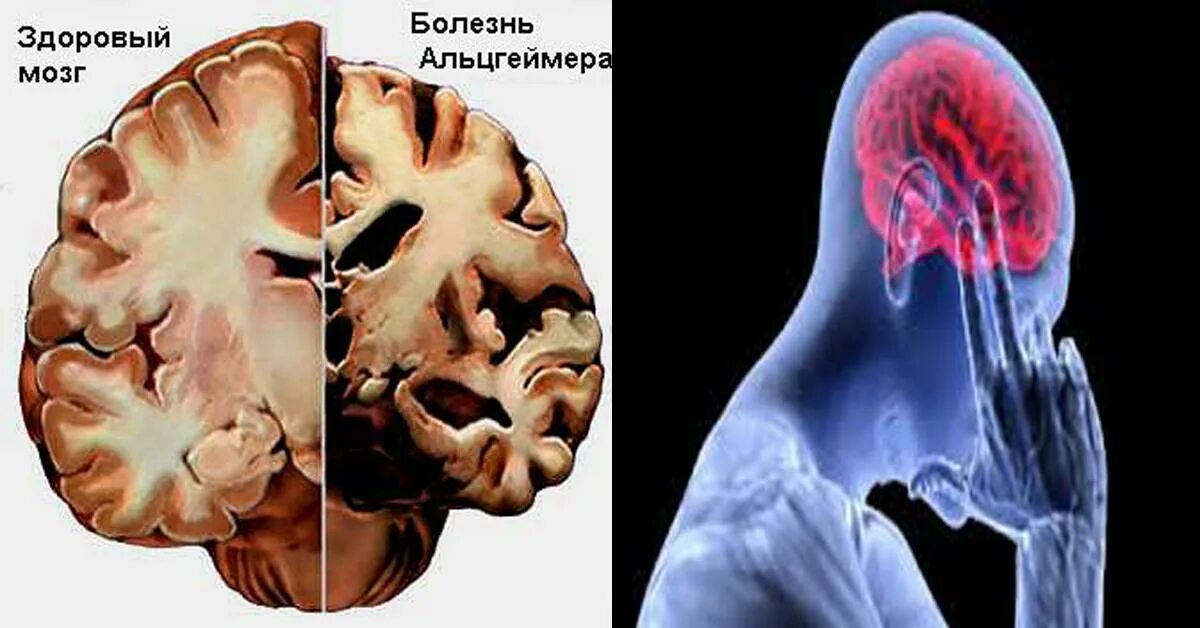 Болезнь Альцгеймера деменция. Мозг болезньальцгецмера. Мозг здорового человека и Альцгеймера. Пациенты с поражением мозга