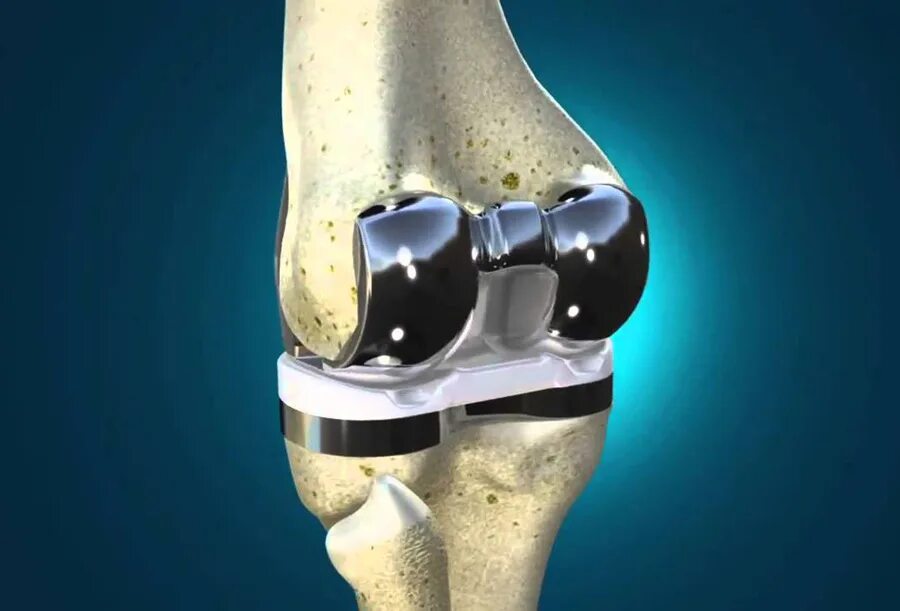 Maxx Orthopedic эндопротез коленного. Genesis 11ps эндопротез коленного сустава. Эндопротез локтевого сустава DEPUY. Биоимплантант коленного сустава.