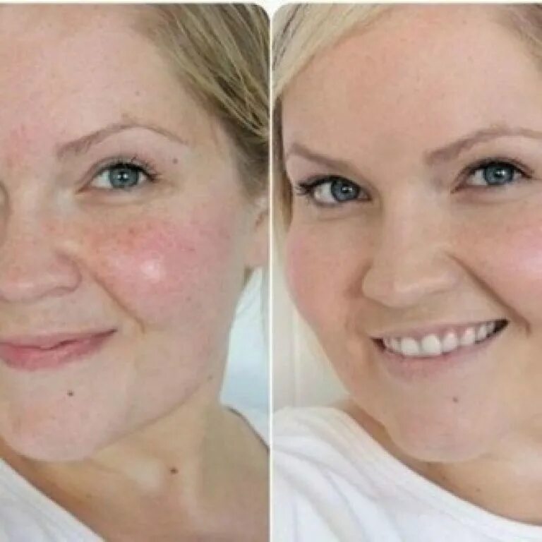 Пилинг сколько нужно процедур. Лицо до и после косметолога. Пилинг для лица.