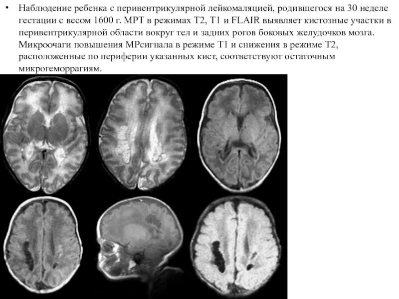 Диффузно атрофические изменения. Перивентрикулярная лейкомаляция кт. Перивентрикулярный лейкоареоз на кт. Перивентрикулярная лейкомаляция у недоношенных мрт. Мрт головного мозга при ДЦП.