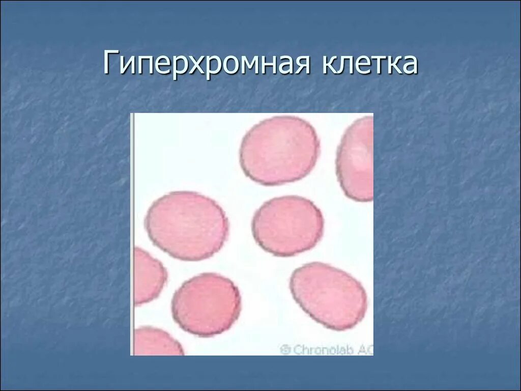 Гиперхромная анемия. Макроцитарная гиперхромная анемия картина крови. Гиперхромная анемия мазок крови. Гиперхромная макроцитарная анемия микроскоп. Клетки с гиперхромными ядрами