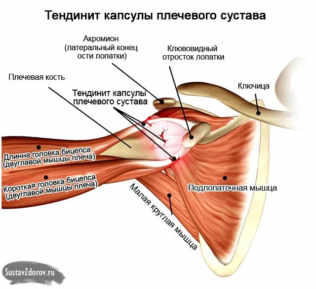 Тендинит мышцы плечевого сустава. Болит правый плечевой сустав причины. Мышцы плечевого сустава анатомия. Тендинит плечелучевой мышцы. Сильно болят плечи причина