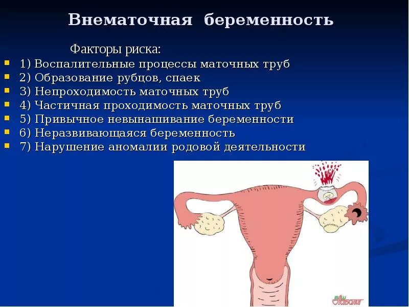 Месячные после удаления маточной трубы. Симптомы прогрессирующей внематочной беременности. внематочная беременность трубная беременность. клинические симптомы прогрессирующей внематочной беременности. внематочнаябеременость.