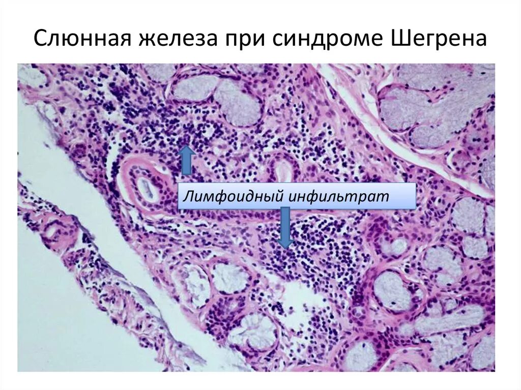 Болезнь шегрена симптомы диагностика. Слюнная железа при синдроме шегрена микропрепарат. Цитомегаловирусный сиалоаденит патанатомия. Синдром шегрена слюнные железы. Синдром шегрена слюнные железы.