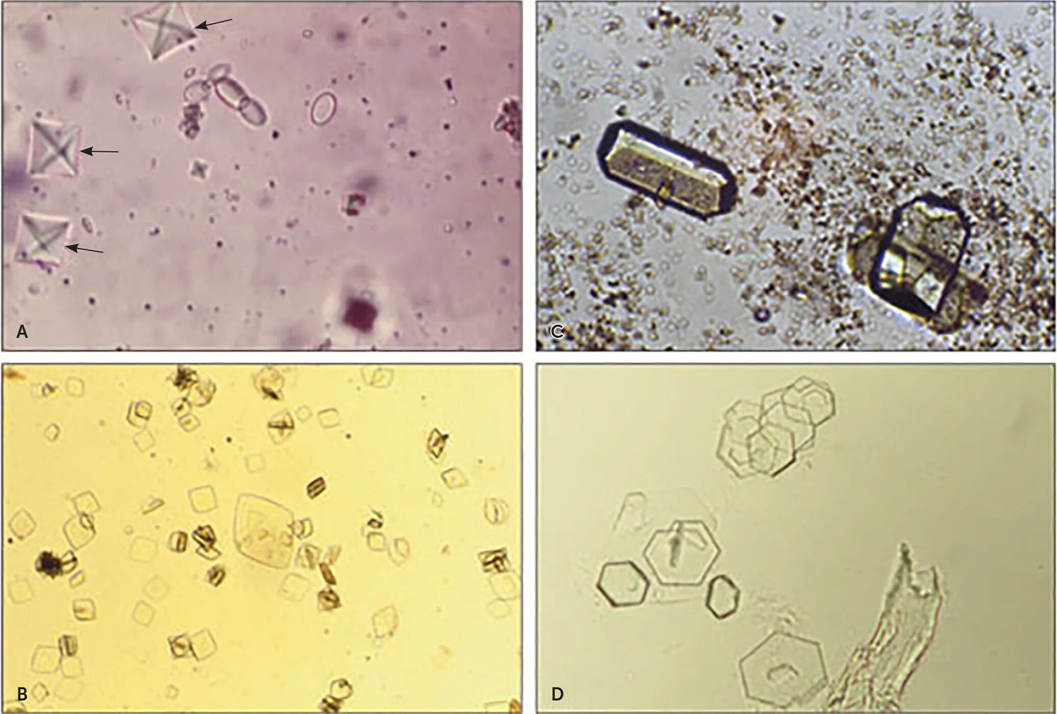 Кристаллы оксалата в моче у мужчин. Кристаллы мочевой кислоты микроскопия. Оксалаты кальция в моче под микроскопом. Струвиты микроскопия. Оксалаты кальция в моче микроскопия.