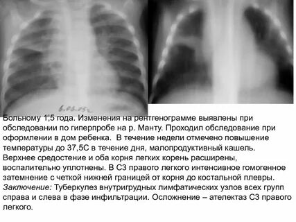 Изменения на рентгенограммах