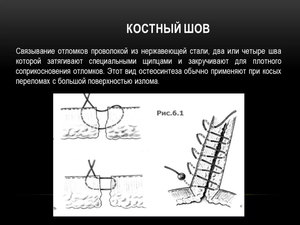 3 8 шов. Проволочный костный шов. остеосинтез проволочным швом.