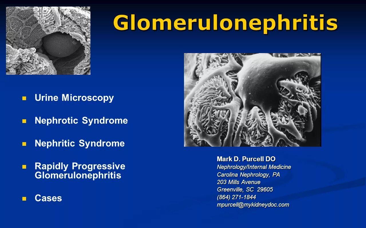 Гломерулонефрит эритроциты. Хронический гломерулонефрит. urine in nephrotic syndrome.