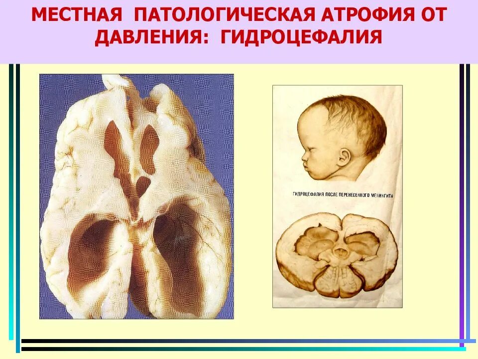 Диффузная атрофия головного. Гидроцефалия патологическая анатомия. Патологическая атрофия. Патологическая местная атрофия. Атрофическая гидроцефалия.