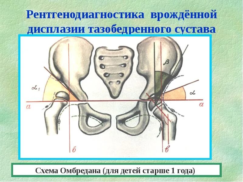 Физиологическая незрелость тазобедренных. Схема хильгенрейнера тазобедренных суставов. ацетабулярный дисплазия. схема тбс дисплазия. дисплазия тазобедренных суставов ацетабулярный угол норма.