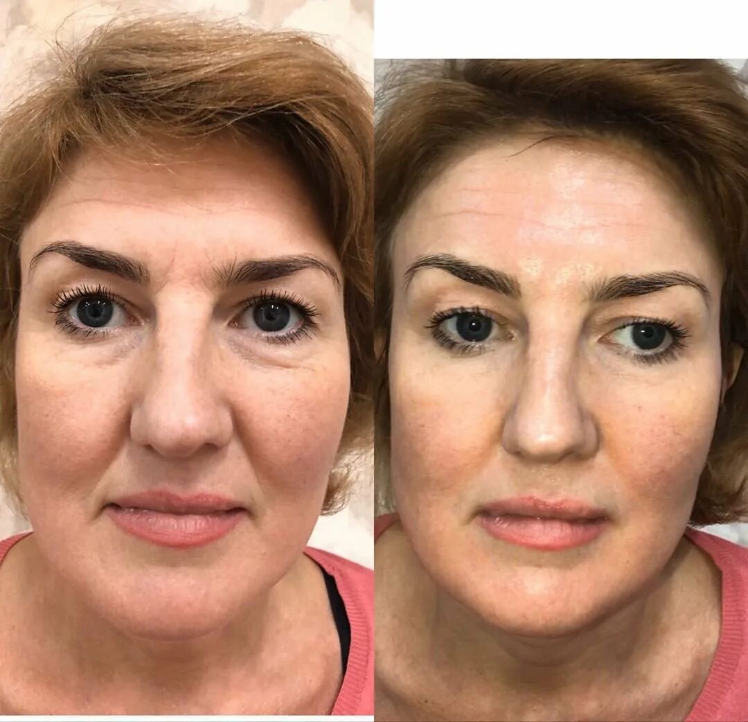 Микротоки лицо до и после фото отзывы. Носослезная борозда ботокс. микротоки для лица lj b gjckt. диспорт в носослезную борозду. носослезная борозда до и после.