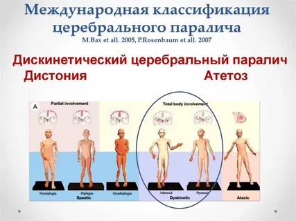 Легкая форма дцп