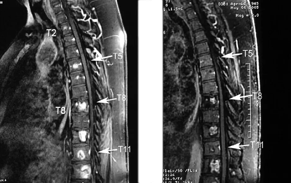 Метастазы в грудном отделе позвоночника на кт. Метастазы в позвоночнике на мрт. Метастазы грудного отдела позвоночника на мрт. Метастаз в теле позвонка на мрт. Опухоль в поясничном отделе