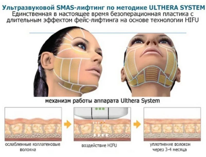 Альтера аппарат для смас лифтинга. Смас лифтинг на аппарате Альтера. Схема ультразвукового смас лифтинга. Аппарат HIFU smas. Процедура подтяжки кожи