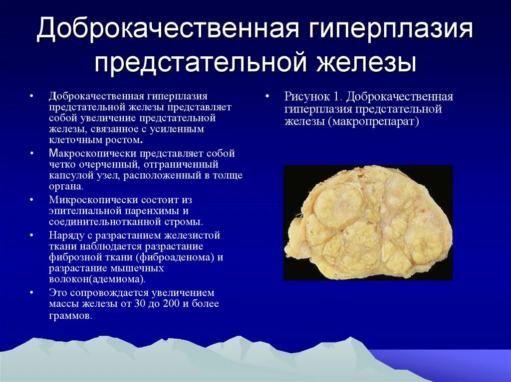 Стадии дгпж. Макро гиперплазия простаты. Доброкачественная гиперплазия предстательной железы макропрепарат. Узловая аденоматозная гиперплазия предстательной железы. Гипоплазия престатильной железы.