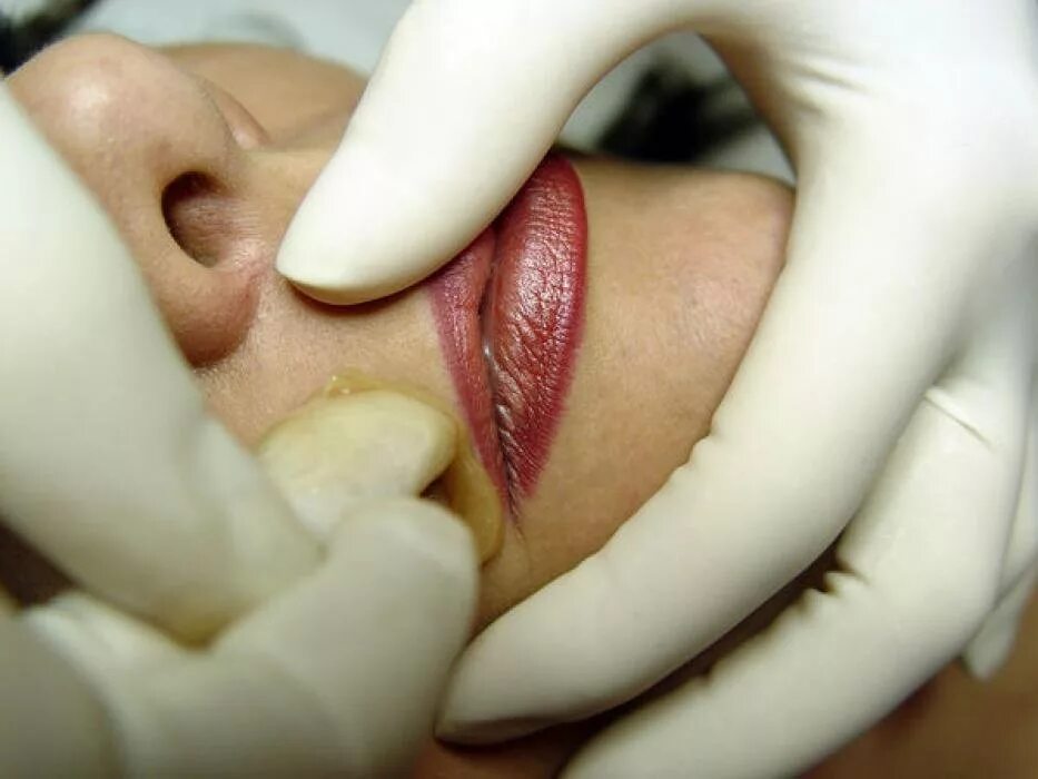 Дезартеризация геморроидальных. Восковая депиляция зоны бикини. Удаление половых губ. Удаление половых губ. Лабиопластика уменьшение половых губ.