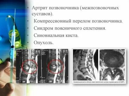 Киста позвоночника массаж