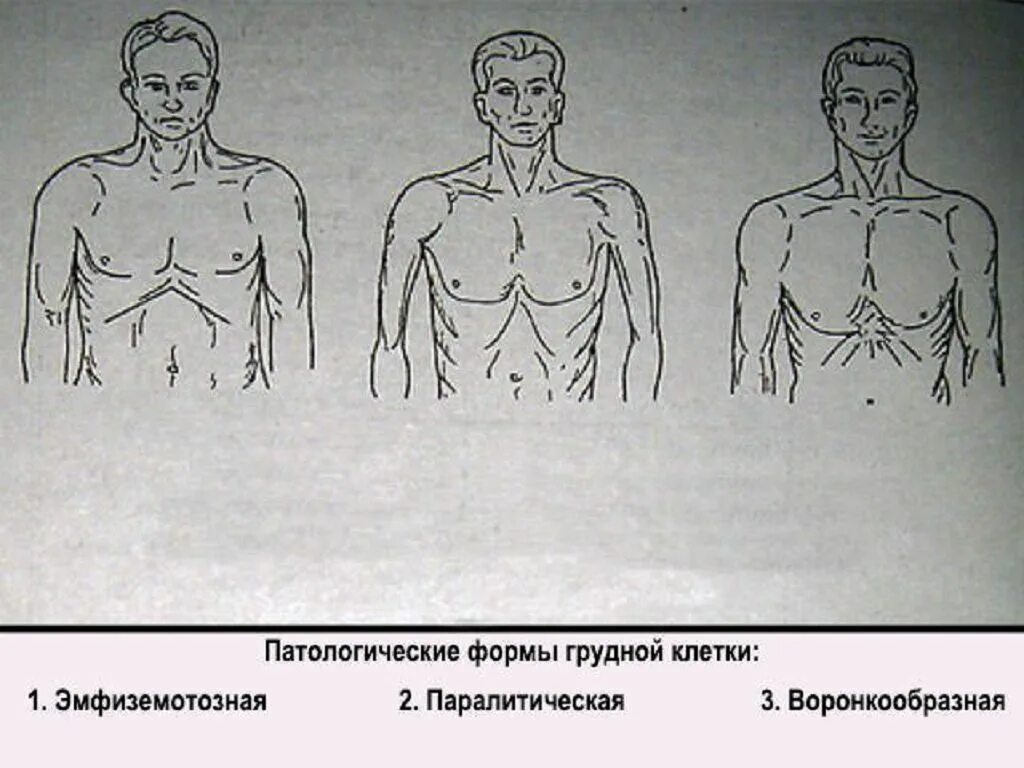 У спортсменов чаще наблюдается форма грудной клетки. Эмфизематозная форма грудной клетки. эмфизематозная (бочкообразная) грудная клетка. формы грудной клетки в патологии бочкообразная. физиологические и патологические формы грудной клетки.