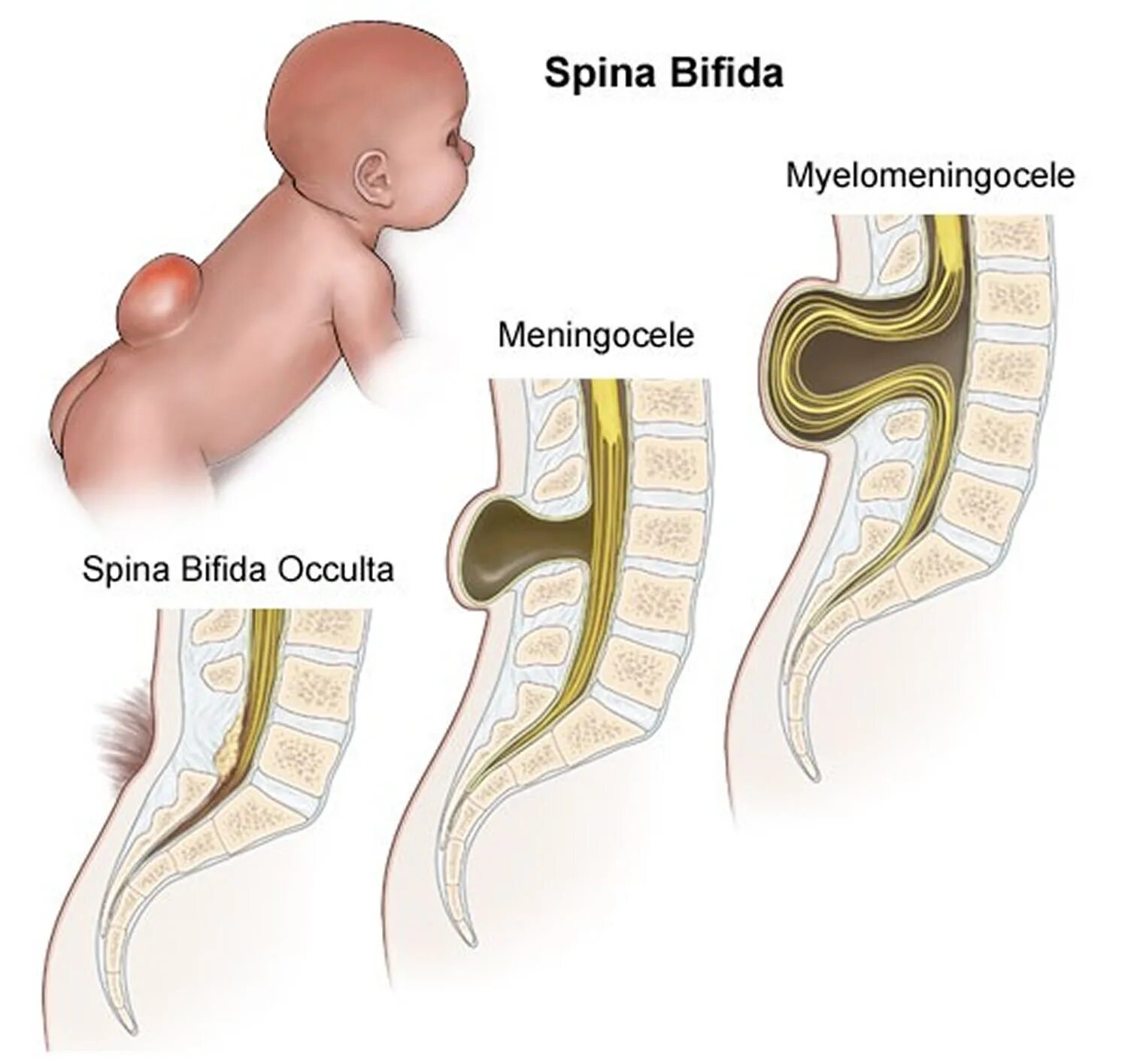 Spina bifida