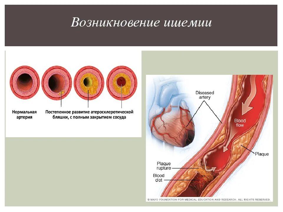 Процесс ишемия. Ишемия виды причины. Причины развития ишемии.