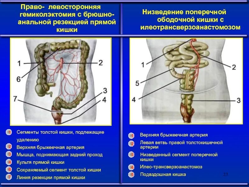 Заболевания ободочной кишки. Поперечная ободочная кишка. левосторонняя гемиколо. резекция поперечно-ободочной кишки. илеотрансверзоанастомоз.