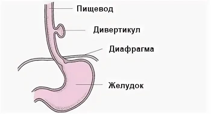 Пищевод отзывы. Дивертикулы пищевода классификация. Дивертикулы пищевода рентген схема. Пульсионный дивертикул пищевода рентген. Тракционный дивертикул пищевода рентген.