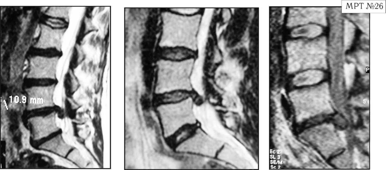 Секвестрированная грыжа l5-s1. Дорзальная секвестрированная грыжа l5/s1. Секвестрированная экструзия диска l5 s1. Экструзия диска l5-s1 что это такое. Экструзия дисков шейного отдела позвоночника