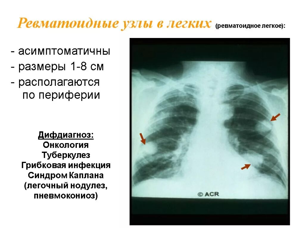 Узлы в легких что это. Ревматоидный артрит кт легких. Поражение легких при ревматоидном артрите кт. Ревматоидные узлы в легких. Ревматоидные узелки в лёгких.