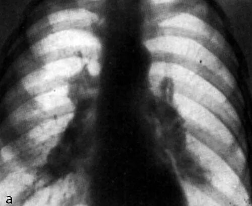 Саркоидоз медиастинальная форма рентген. Саркоидоз легкого рентгенограмма. Расширение корня легкого на рентгенограмме. Увеличение лимфоузлов в легких причины