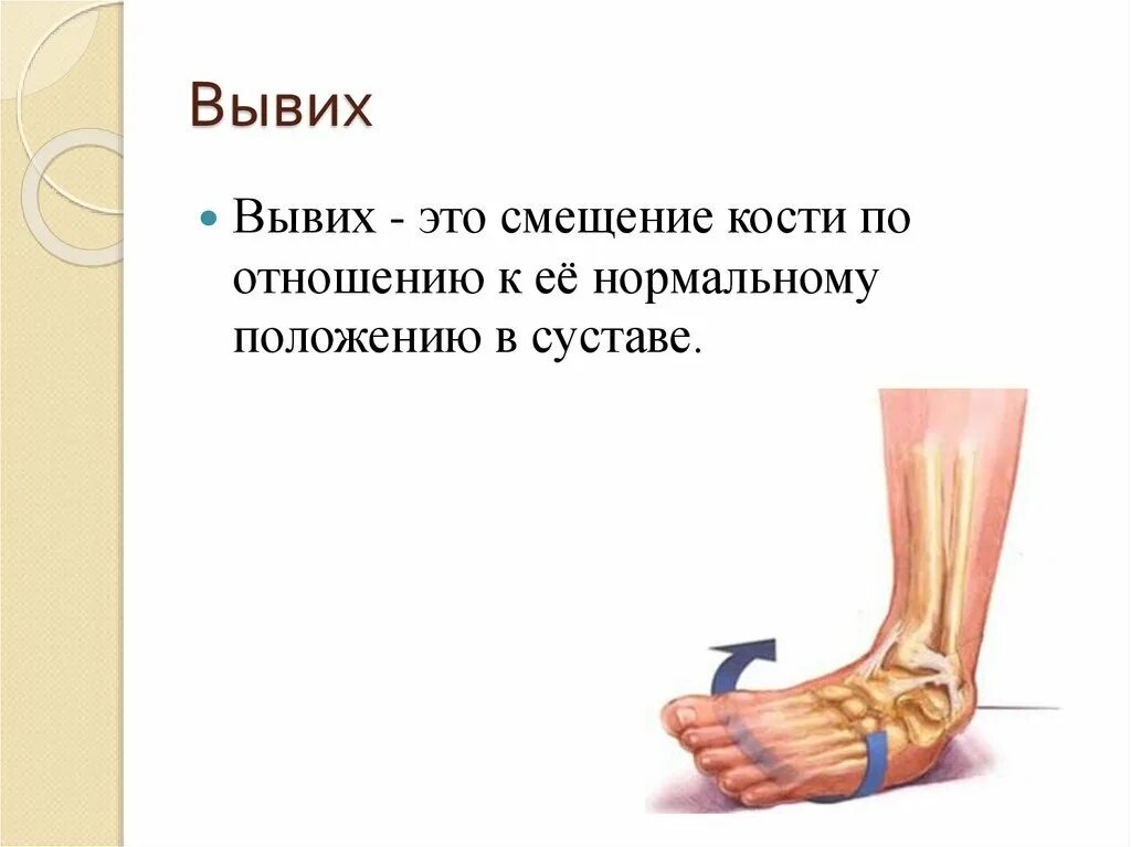 Растяжение связок называется. Растяжение связок называется