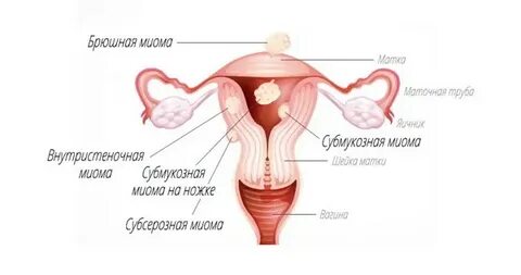 Женская консультация миома